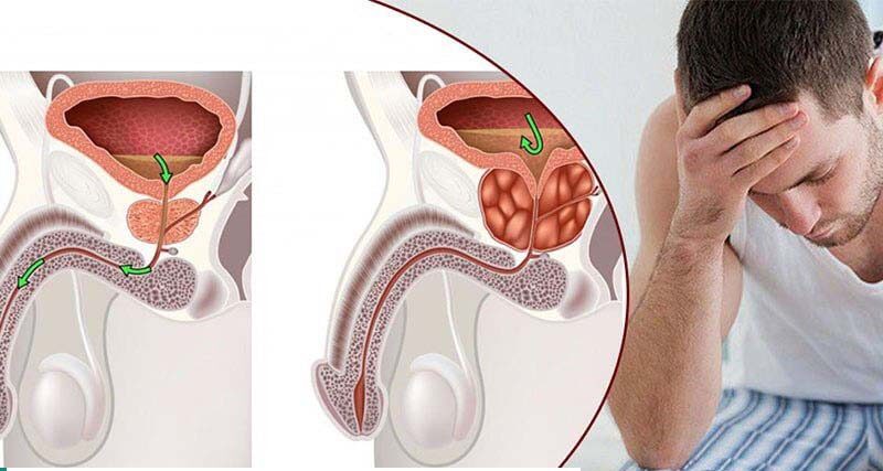 Phì đại tiền liệt tuyến có chữa khỏi được không?