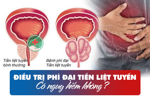 Điều trị phì đại tiền liệt tuyến có nguy hiểm không?