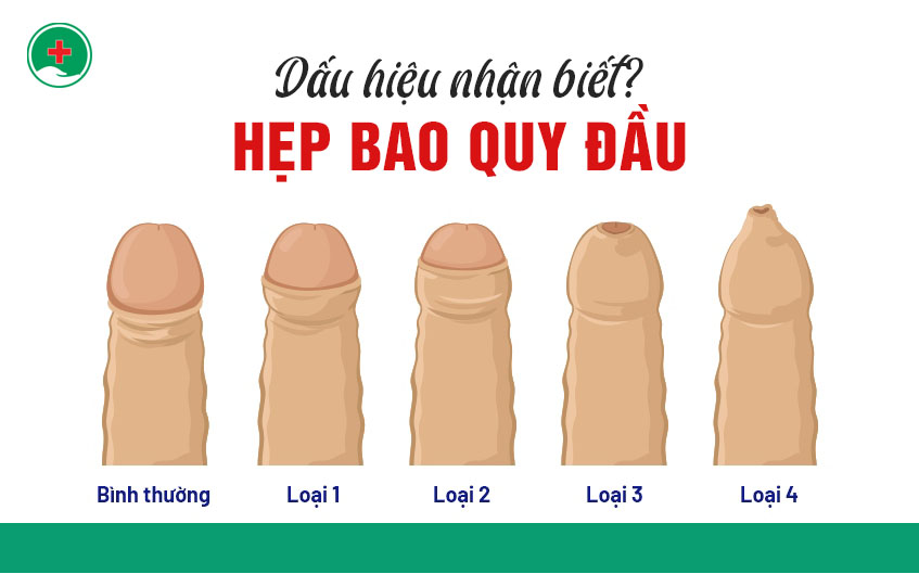 Hẹp bao quy đầu ở trẻ 4 tuổi có nguy hiểm không?