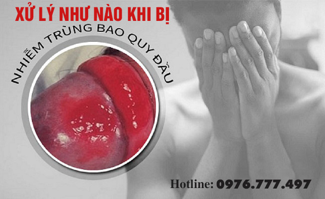 Cắt bao quy đầu bị nhiễm trùng xử lý như thế nào?