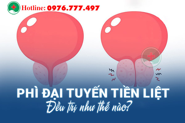 Bệnh phì đại tuyến tiền liệt điều trị như thế nào?